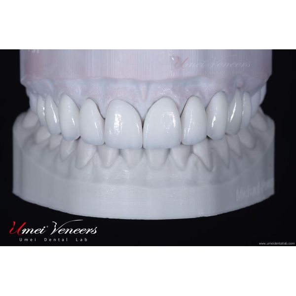 Natural Hollywood White Veneers