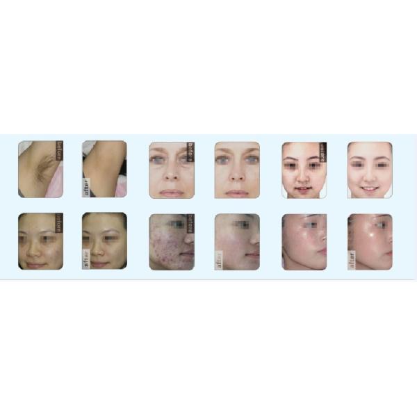 2016 hot sale Nubway E light IPL SHR three in one unit hair removal skin rejuvenation machine with CE FDA approval