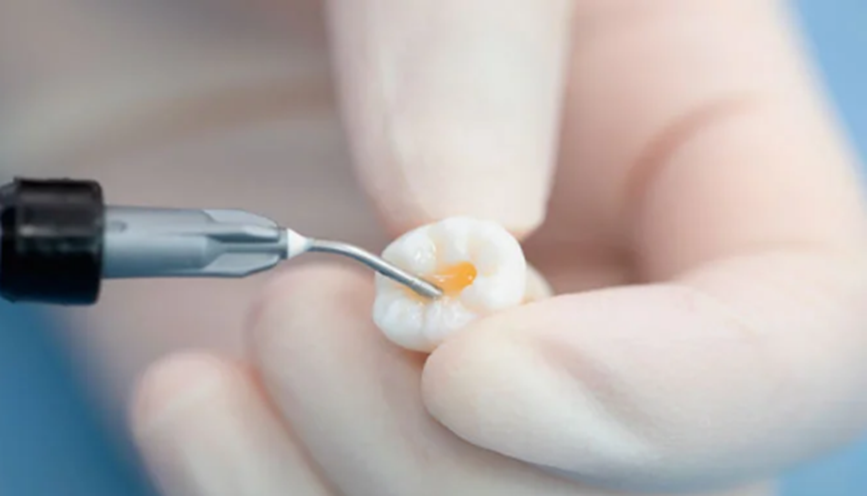 Low Viscosity Light-Cured Bis-GMA Flowable Resin | A Dental Restorative Material