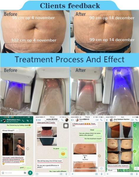 4 handpieces fat reduction cryotherapy fat freezing cryolipolysis slimming machine for sale