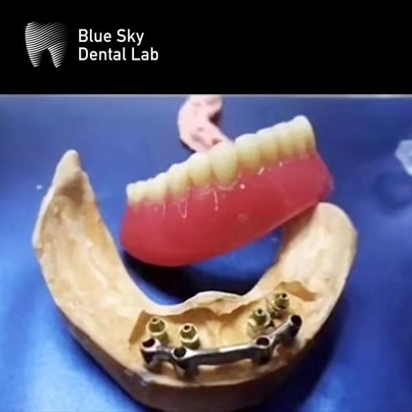 Implante dental de titanio para la boca completa