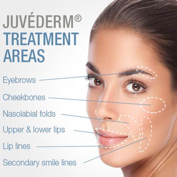 Перекрестно-связанный кожный наполнитель Juvederm 1x2 мл Juvederm Volbella Lip Filler 24 мг / мл