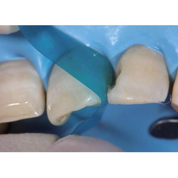 Sectional Contoured Anterior Matrix Band Dental Anterior Teeth Matrix M8