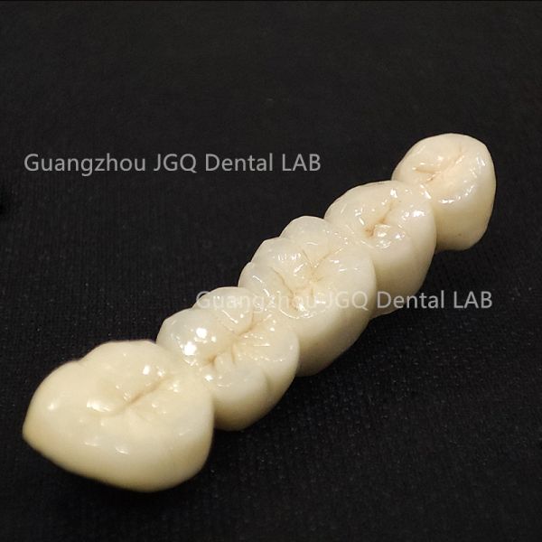 Co Cr Dental Pfm Crowns and Bridges Fixed Denture Restorations China Dental Lab