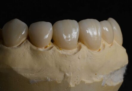 Anterior Multilayer Dental Zirconia Block B2 D98*18mm For Aesthetic Restoration