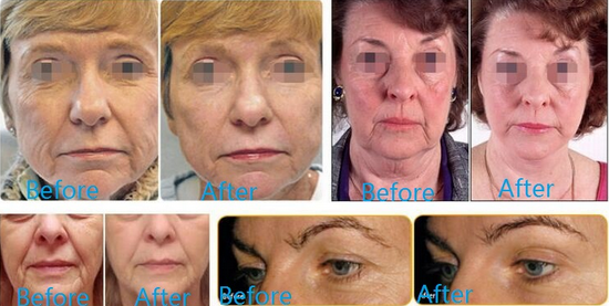 Face Lift HIFU Machine / Hifu Therapy With High Frequency 7Mhz