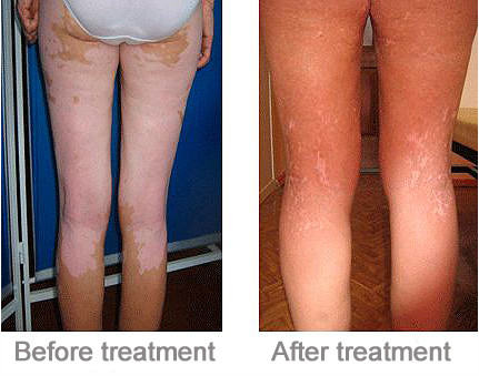 Phillip UV Lamp UVB Phototherapy Equipment For Treatment / Psoriasis / Vitiligo