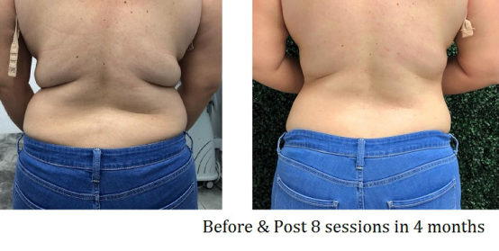 Touchscreen 5 In 1 vacuum cavitation Machine For Stretch Marks