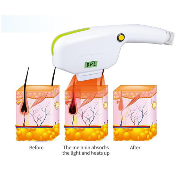 3000W 2 Handles DPL NIR Skin Rejuvenation Fast Hair Removal Machine