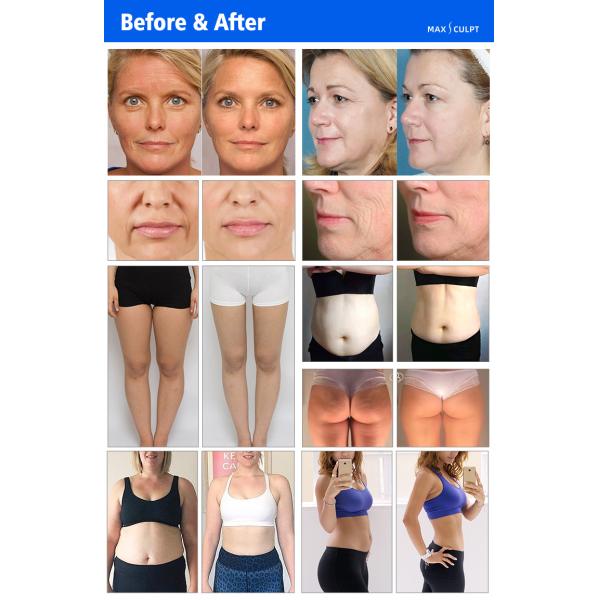 Machine de réduction de graisse par radiofréquence et cavitation sous vide VelaBody, machine de remodelage corporel et de perte de poids sous vide