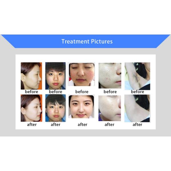 Two Handles Two Screen 2000W Permanent Painless Hair Removal And Skin Rejuvenation SHR IPL Machine