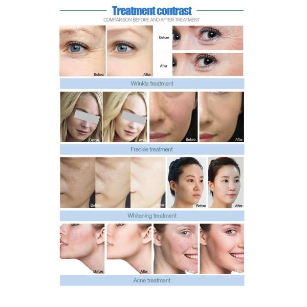 High Pressure Hydra Peeling Hydrotherapy Machines for Deep Cleansing and Rejuvenation