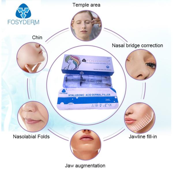 Hyaluronic кисловочный дермальный вводимый заполнитель для стороны носа