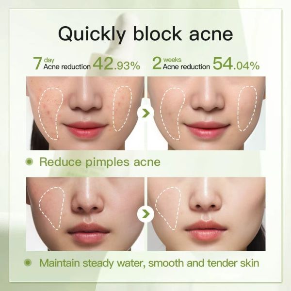 Green Tea Acne Serum Pore Shrinking Facial Oil Control Treatment for Oily Skin Anti-Aging Whitening Gold Stamping Logo OEM