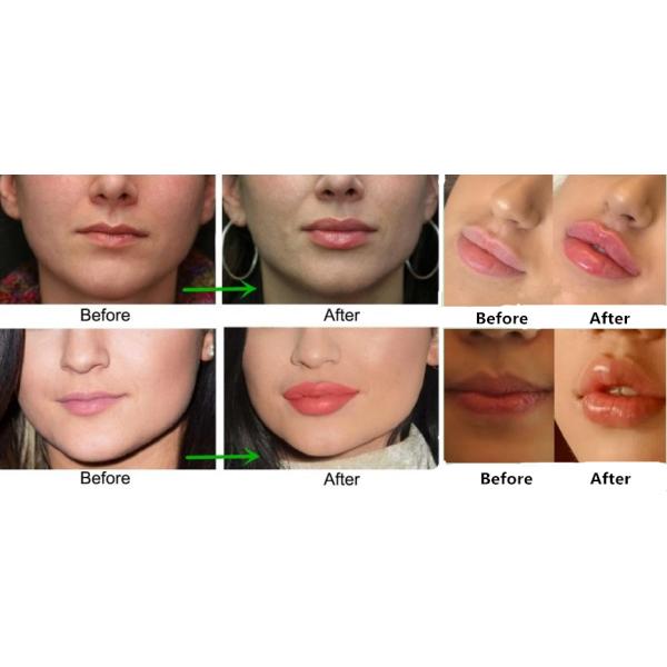 Впрыска Juvederm 2x1ml заполнитель 24mg/Ml ультра 3 губ дермальный