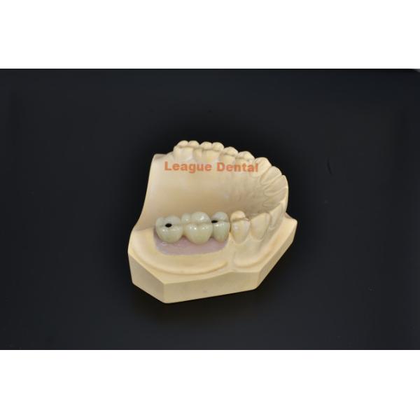 Missing Tooth Implant Bridge Titanium Implant Bridge Durable Replacement