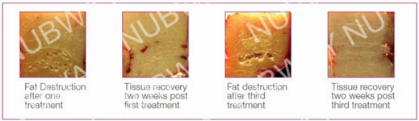 2017 newest non-invasive RF vacuum aesthetic HIFU face and body slimming machine