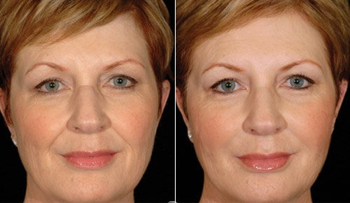 Quadril profundo médio do nariz da cara da injeção das nádegas do Ha do enchimento da pele 1.1ml Rejeunesse