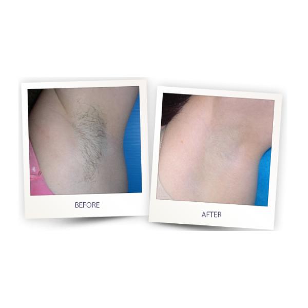 Safety 808nm Diode Laser Hair Removal Machine Water Temperature Self - Checking