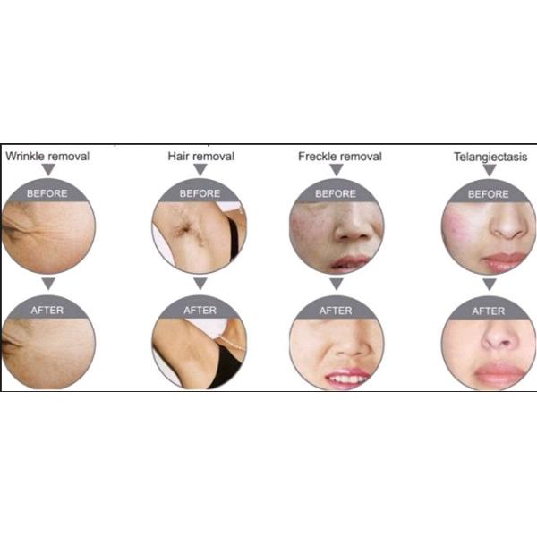 Opt Shr Epilation IPL Skin Therapy Machine Virtually Painless , Long Lifetime