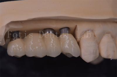 Precision Fit Dental Implant Crowns Titanium / Zirconia / PFM Restoring Missing Teeth