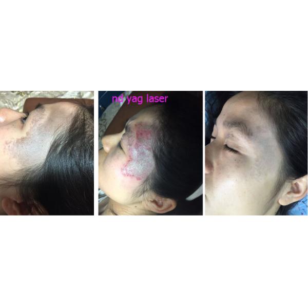 Stationary Q - Switched ND Yag Laser Tattoo Temoval Beauty Machine