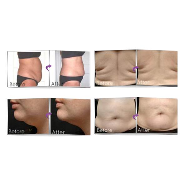 35 * 38 * 58cm HIFU Machine , English Language Non Surgical Face Lift Machine