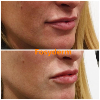 Transparent Dermal Lip Fillers For Lip Plump