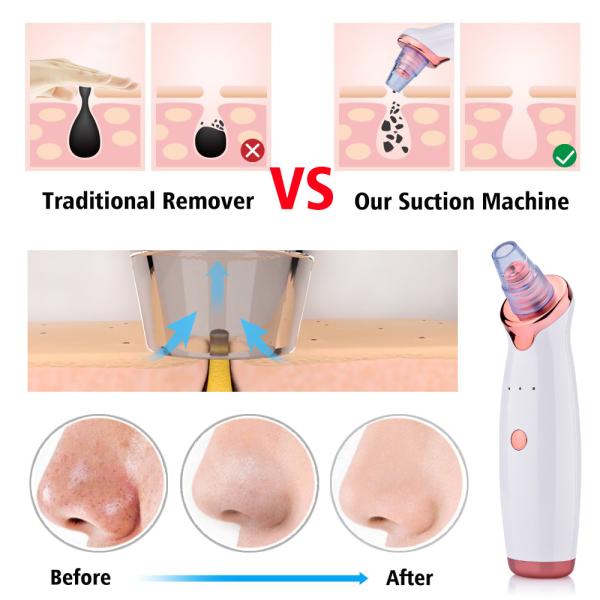 The Most Effective Blackhead Vacuum Acne Cleaner Pore Remover Electric Skin Facial Cleanser Care Pore Cleaner