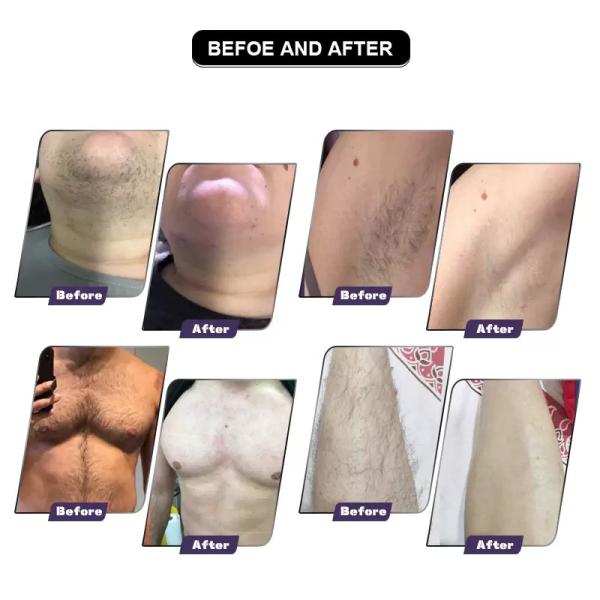 Platinum 808nm Diode Laser Hair Removal Machine Alexandrite Skin Rejuvenation