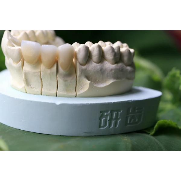 Fixed Prosthetics Permanent Solution EMAX Dental Crown