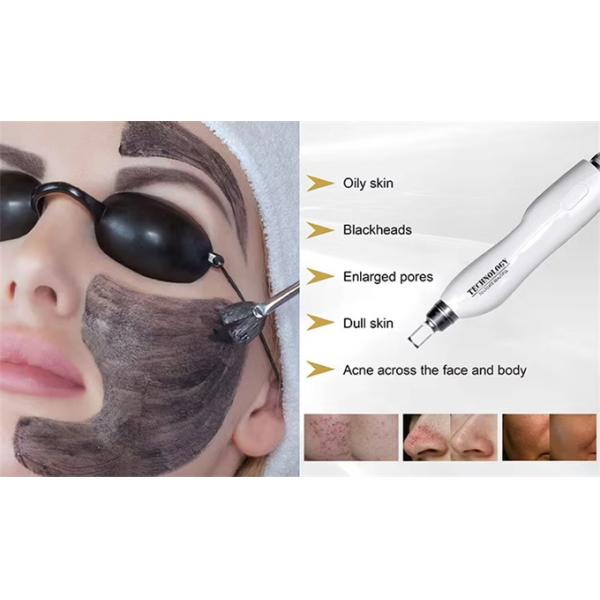 Портативный пикосекундный лазер Nd Yag с длиной волны 3 для удаления пигмента