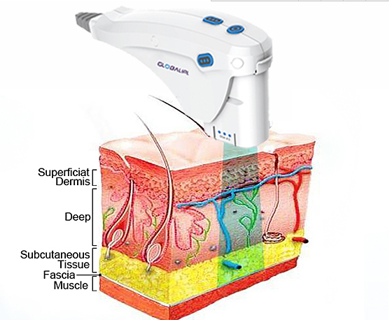 Women Use Hifu Beauty Machine 4MHz HIFU Frequency For Skin Rejuvenation / Pore Removal