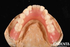 Lightweight Good Biocompatibility Acrylic Denture Finish Personalized Customizat