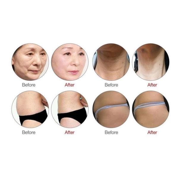 Высокая интенсивность сфокусировала тело машины ультразвука ультразвука ХИФУ/ХИФУ уменьшая машину