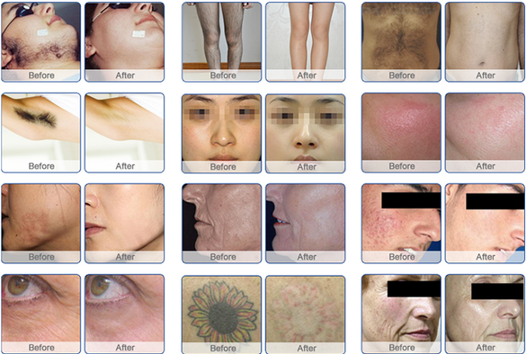 Double Screens Permanent E - Light IPL RF Machine For Face / Leg / Body Hair Removal