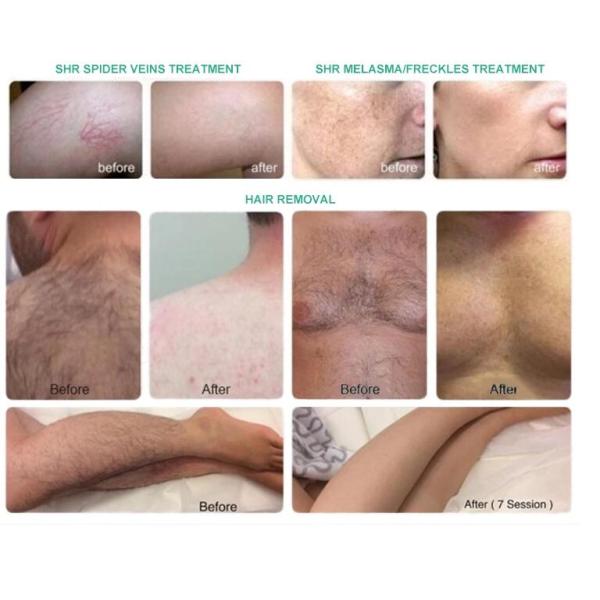 Two - Handle Type IPL Hair Removal Machine For Full Body FDA Approved