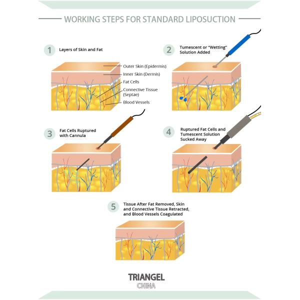 980nm 1470nm Diode Laser For Liposuction Hemorrhoid Removal Vaginal Tighten And Varicose Veins