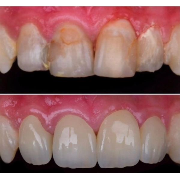 Yucera 4D Pro Zirconia Blocks the Choice for High-Quality Dental Restorations