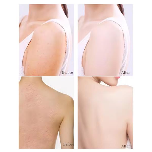 Esfoliante de Corpo Niacinamida Anti-Envelhecimento Esfoliante Morto de Celulite