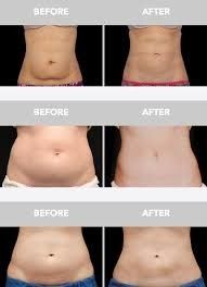 Butt Vacuum Slimming Machine