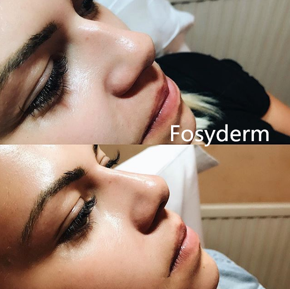 Укреплять Hyaluronic кисловочный дермальный уход за лицом заполнителя складывает вызревание удаления анти-