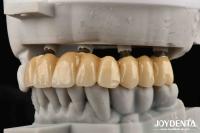 Close Friends Of Bones Foundation Of Beauty Zirconia Implants Aesthetically Supreme Choice With No Risk Of Metal Allergy