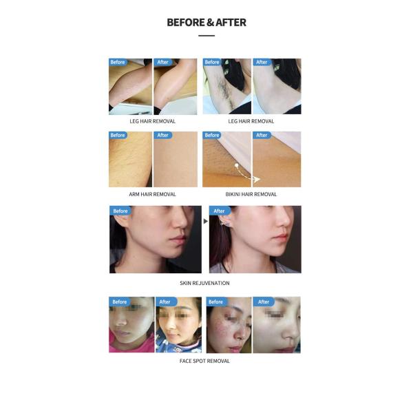 640nm-950nm OPT SHR Elight Hair Removal Machine For Skin Tightening