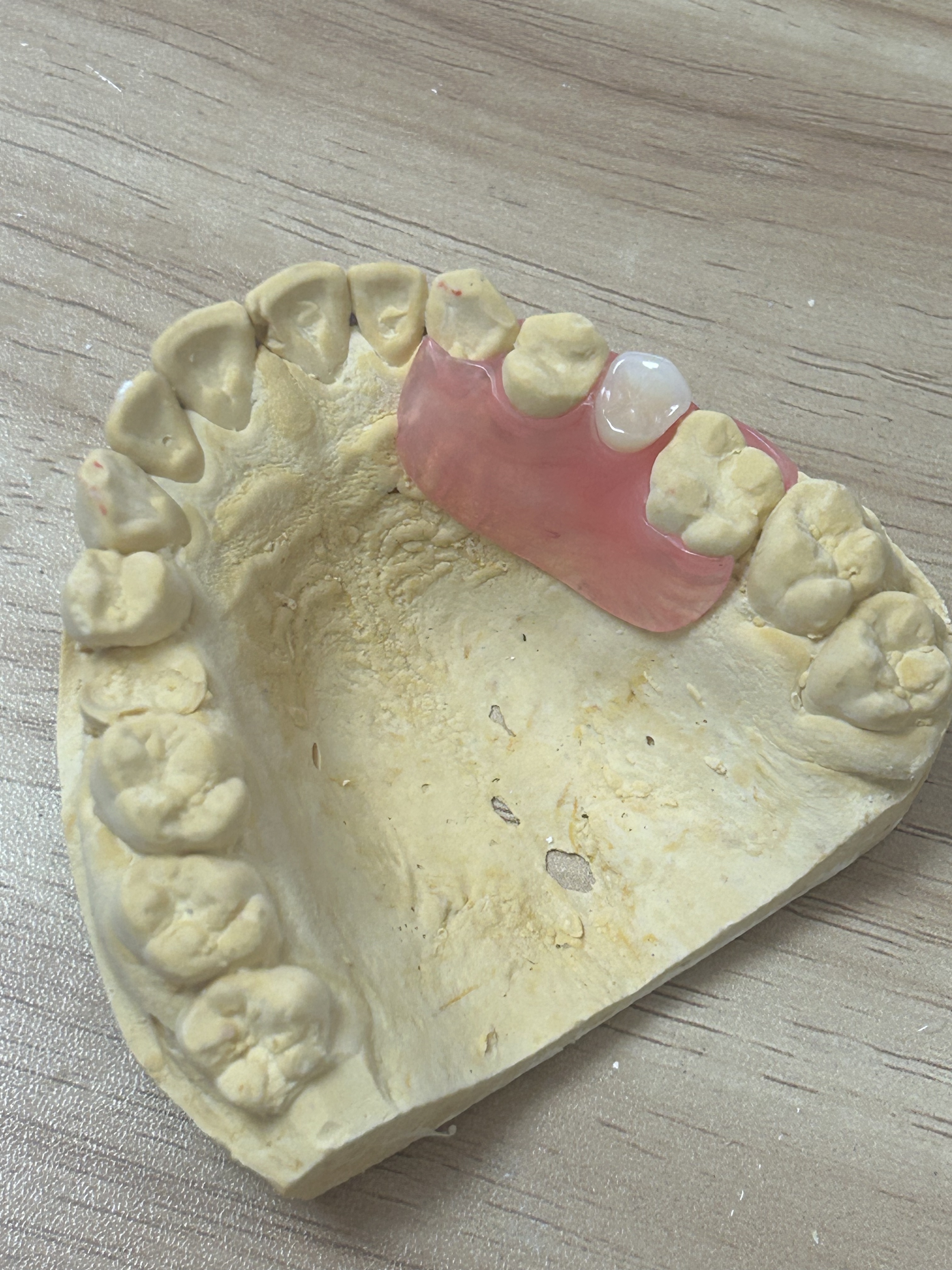 Lightweight Comfortable Discreet Appearance Removable Denture Base and Flexible Denture Base for Esthetic Partial Dentures