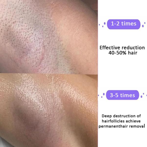 2500W Diode Laser Hair Removal Machine with 150J/cm2 Energy 20 Million Shots Longevity