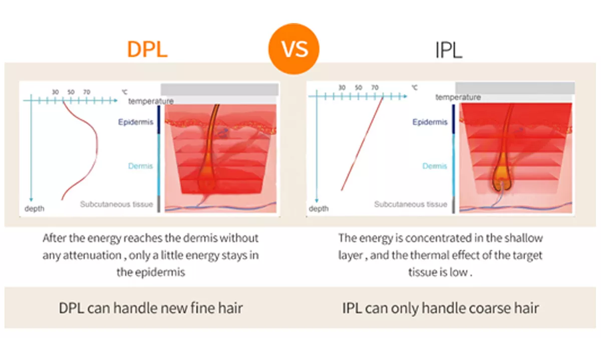 Многофункциональные 3 в 1 подмолаживании кожи удаления волос лазера OPT DPL IPL постоянном/васкулярной машине удаления