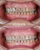 Lightweight Dental Zirconia For Optimal Patient Experience Natural Color Transitions And Biocompatibility Guaranteed