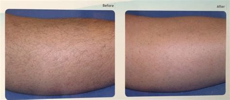 Fast Treatment Laser Body Hair Removal Machine Single Phase Grounded Outlet