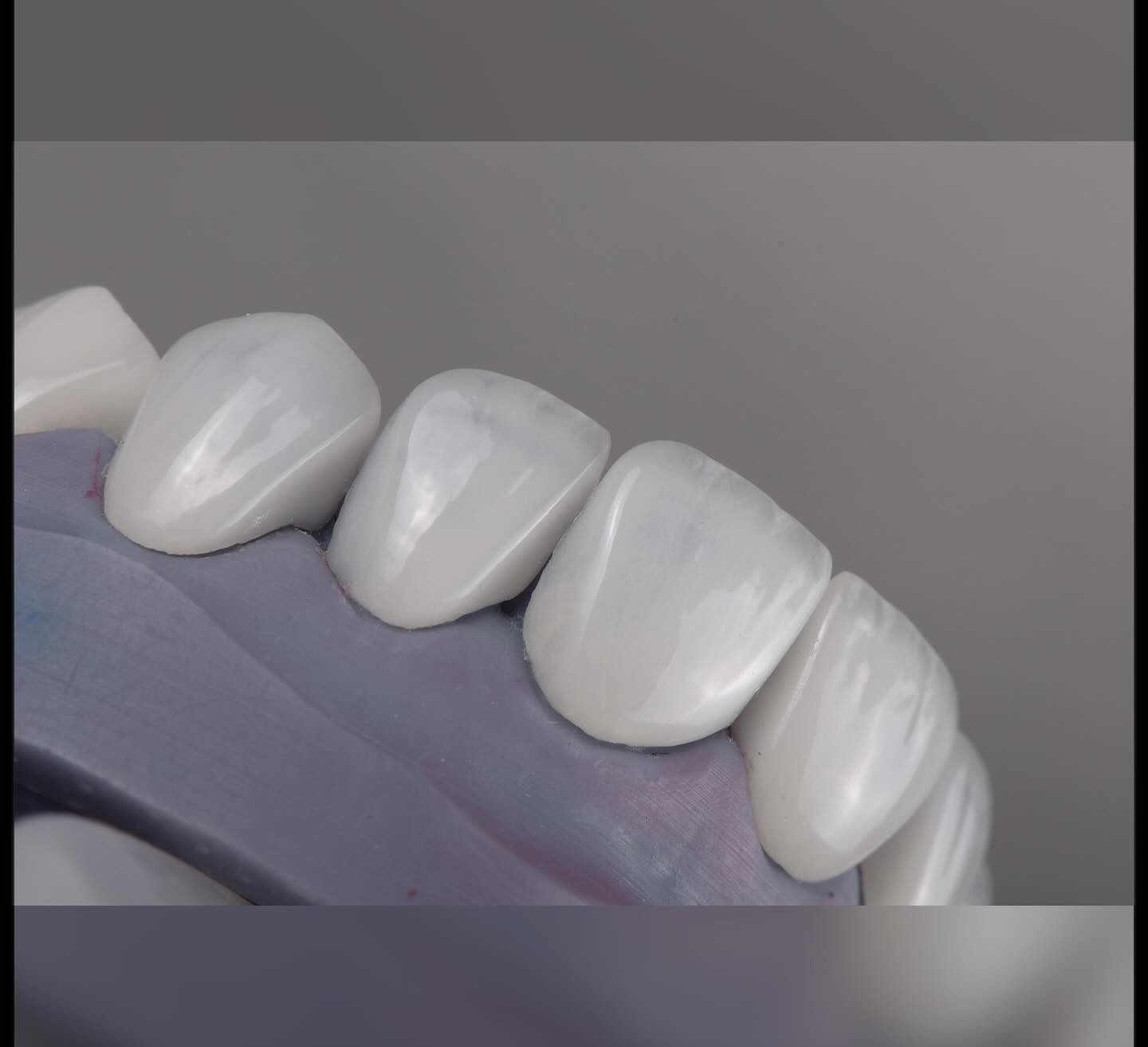 Естественный вид Emax Veneers Crown Biocompatibility Bleaching Shade с минимальной подготовкой